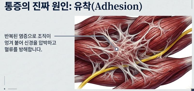 서울 도침치료 한의원의 일반 침과 도침 형태 비교 및 유착 박리 원리