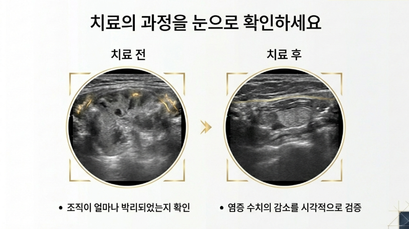 성북구 도침치료 시 초음파 가이드를 통해 신경과 혈관을 확인하는 정밀 시술 장면