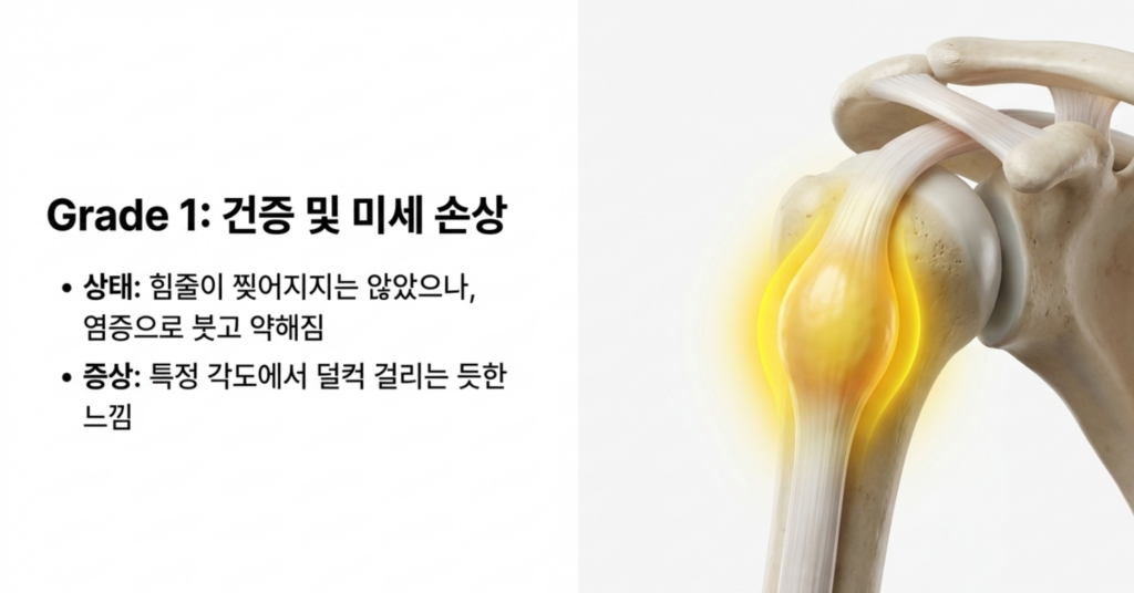 성북구 어깨통증의 주범인 회전근개 파열의 단계별 진행 과정과 힘줄 손상 부위 모식도