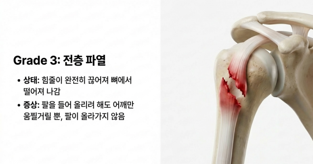 성북구 어깨통증의 주범인 회전근개 파열의 단계별 진행 과정과 힘줄 손상 부위 모식도