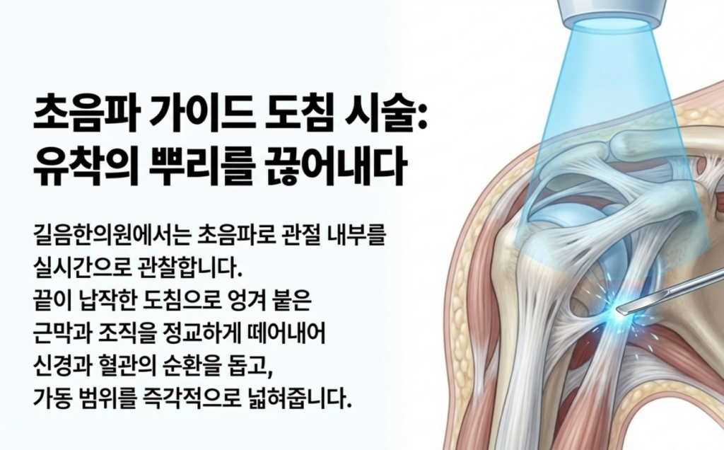 길음역 한의원에서 시행하는 초음파 가이드 도침 시술을 통한 어깨 관절 내 유착 박리 장면