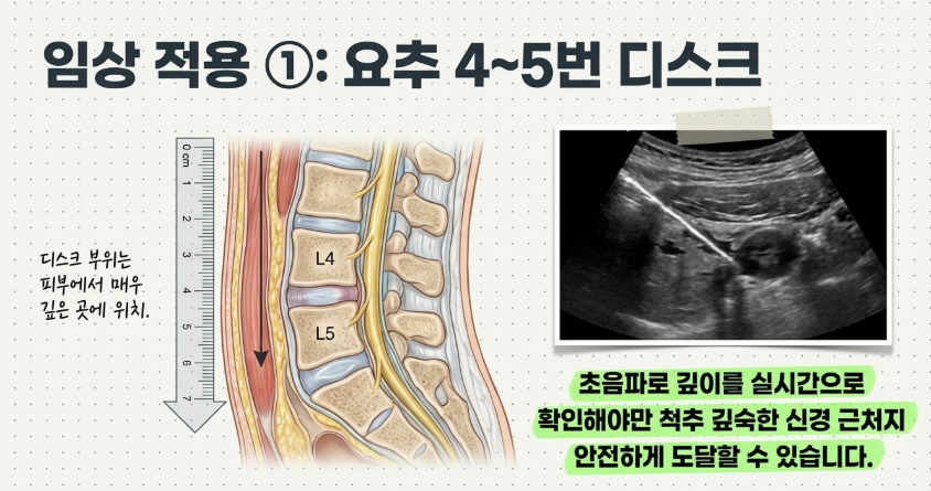 초음파 기기로 요추 45번 디스크 부위의 깊이와 신경 위치를 실시간으로 확인하는 검사 장면