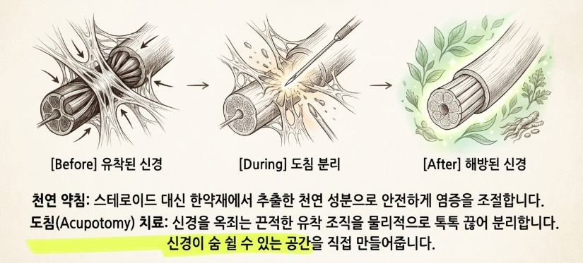 초음파 기기를 사용하여 신경이 눌린 정확한 위치를 찾아내고 약침으로 염증을 조절하는 치료 장면