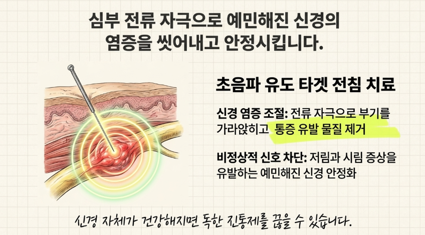 초음파 가이드 하에 도침을 사용하여 끈적하게 달라붙은 조직을 분리하고 신경 통로를 확보하는 시술