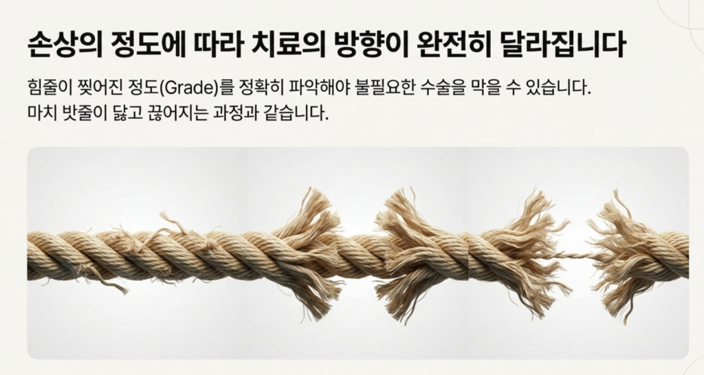 성북구 어깨통증의 주범인 회전근개 파열의 단계별 진행 과정과 힘줄 손상 부위 모식도