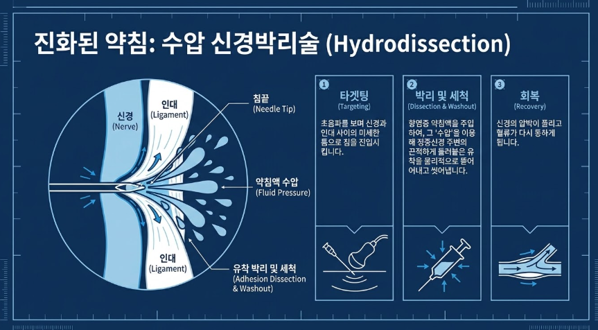 손목터널증후군 약침치료의 수압박리술 원리