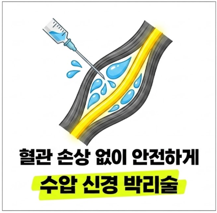 손목터널증후군 침치료와 초음파 가이드 시술의 효과기전
